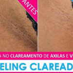 clareamento-virilha-axilas-3005-5953_2